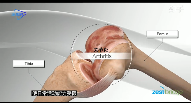人工膝盖置换术3D动画示意图