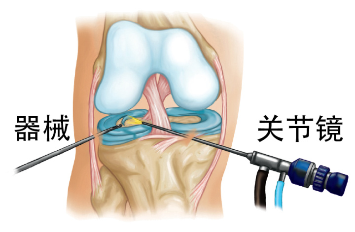 关节镜手术的那些事