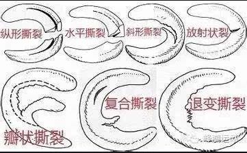 半月板的解剖及损伤分型