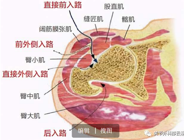 髋关节置换手术的传统入路与DAA微创入路