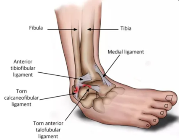 足踝扭伤根据严重程度可以分为三个等级：