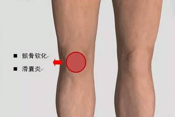 一分钟搞懂你的“膝盖痛”