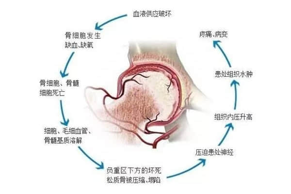 股骨头坏死后股骨头变形、塌陷怎么办？