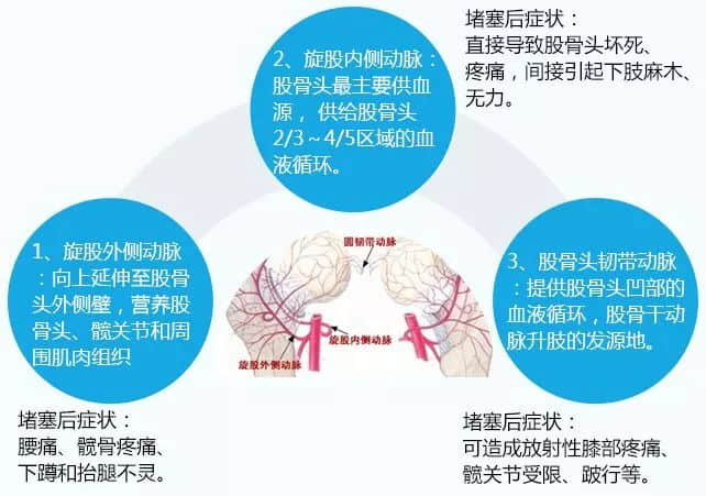 股骨头坏死患者为什么不能久站或久坐