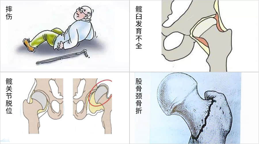 股骨头坏死的原因都在这,该如何预防股骨头坏死?