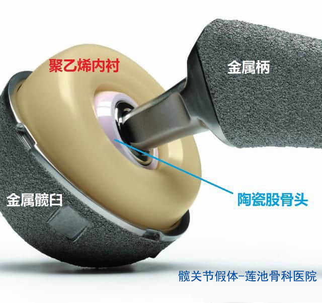 人工髋关节假体中 陶瓷和金属有什么区别