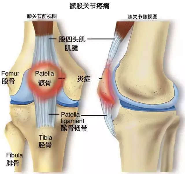莲池骨科医院-髌骨疼痛综合和跑步膝是什么关系