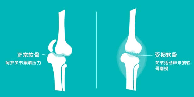 膝关节痛是不是一定要做关节置换?老年人膝关节疼痛应该如何治疗呢？