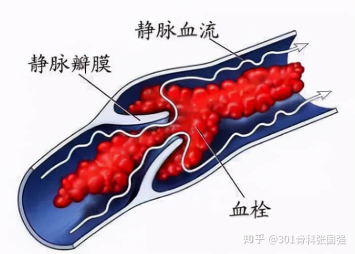 年龄「越大」，膝关节置换手术风险「越高」吗？