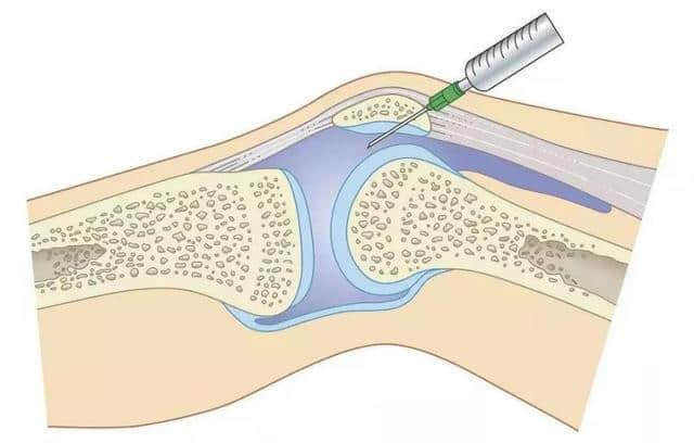 关节炎玻璃酸钠针，打还是不打？