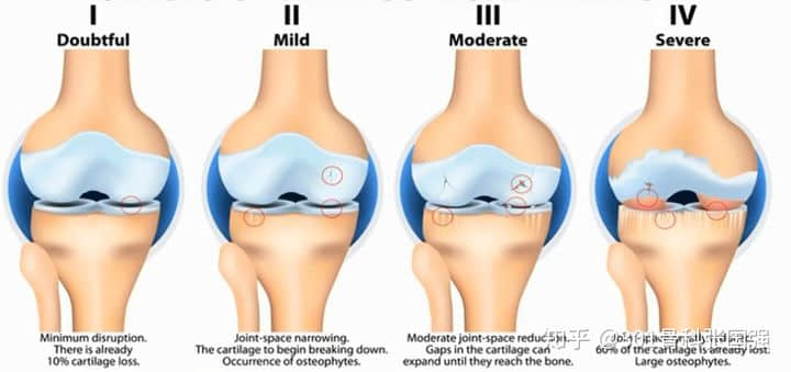 什么情况下适合做膝关节置换术？