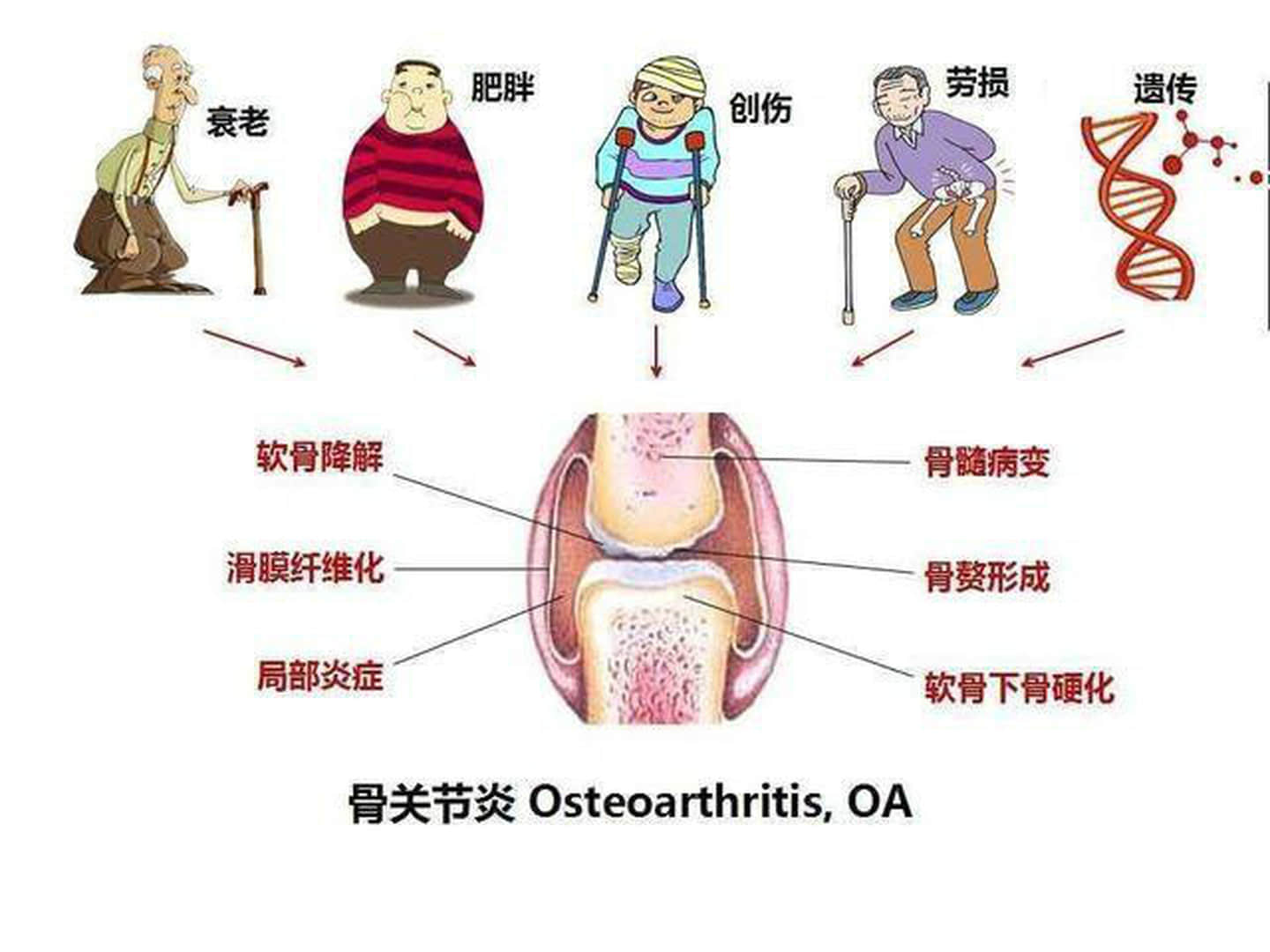 退行性骨关节炎怎么治