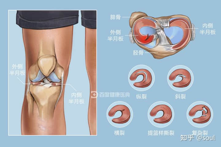 半月板成形术手术及恢复