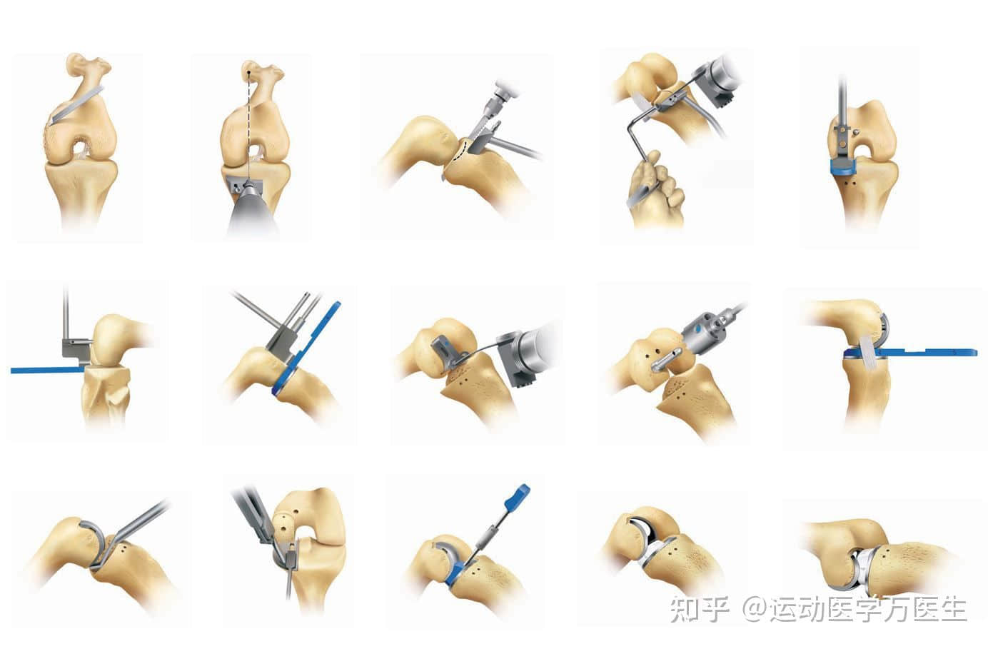 膝盖疼医生建议换一半关节