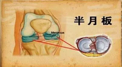 半月板损伤常见问题