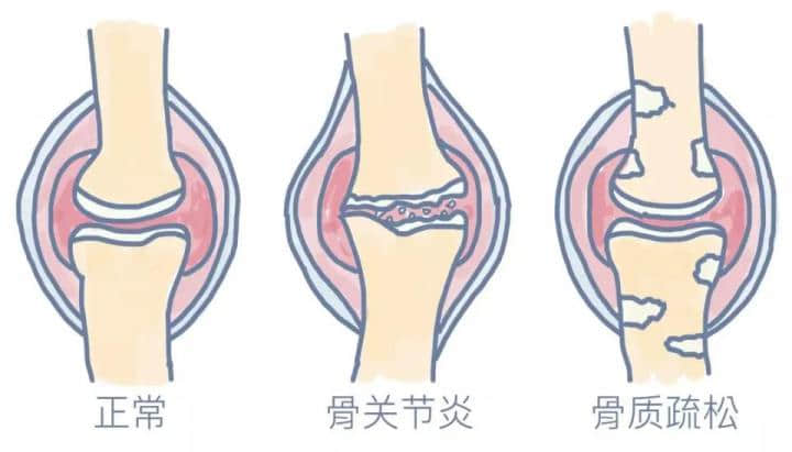 骨关节炎的自测 如何科学有效的预防骨关节炎？