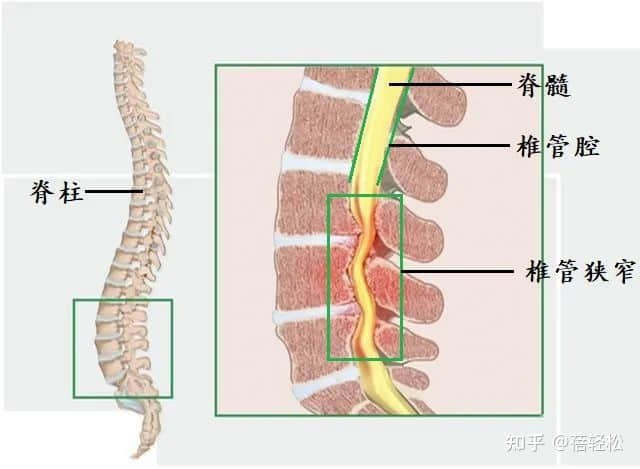 椎管狭窄是什么意思？严重吗?