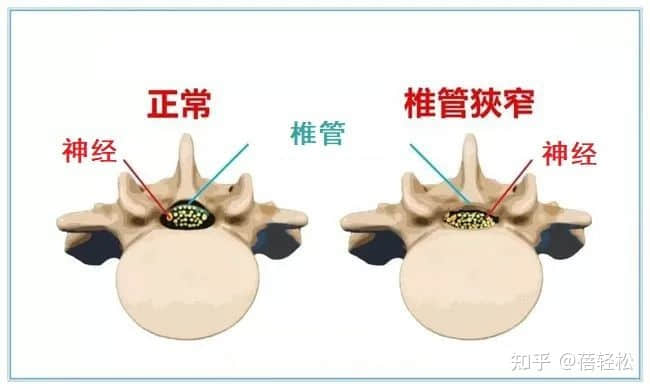 椎管狭窄是什么意思？严重吗?