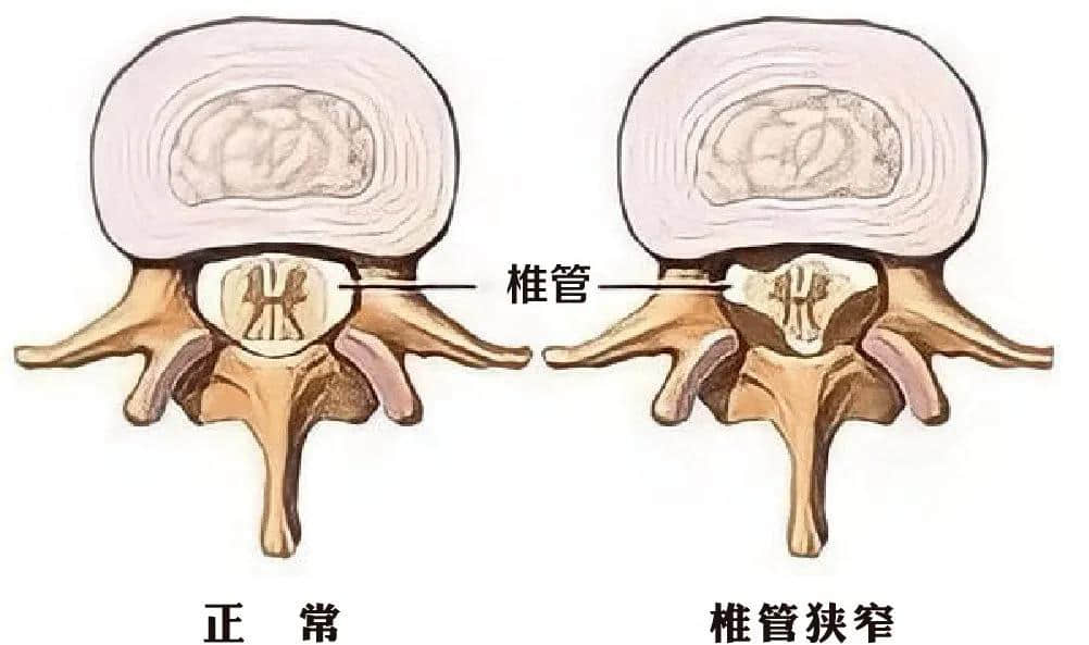 腰椎椎管狭窄症？试试UBE技术！