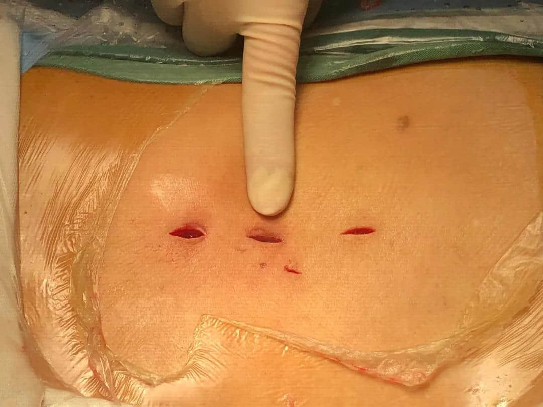 腰椎椎管狭窄症？试试UBE技术！