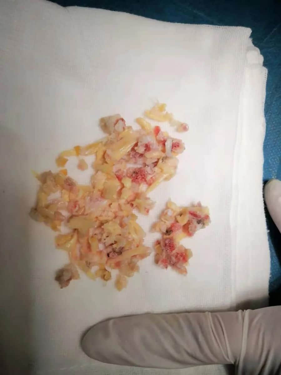 腰椎椎管狭窄症？试试UBE技术！