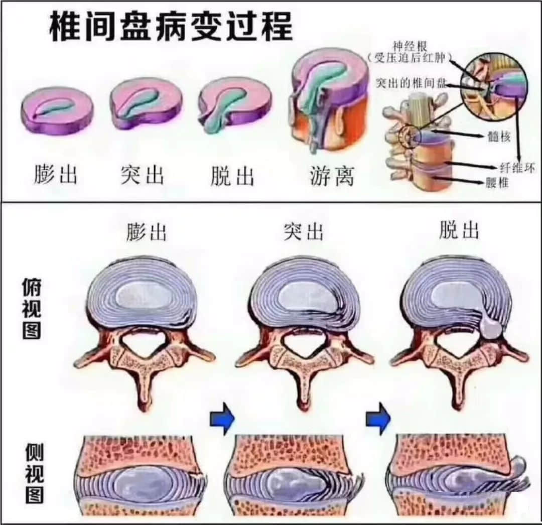 腰椎间盘突出，纤维环破裂是怎么回事？这种情况需要治疗吗？